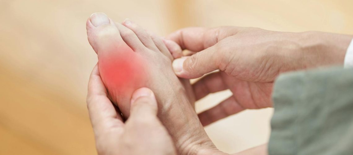 Comment soulager une crise de goutte naturellement ?